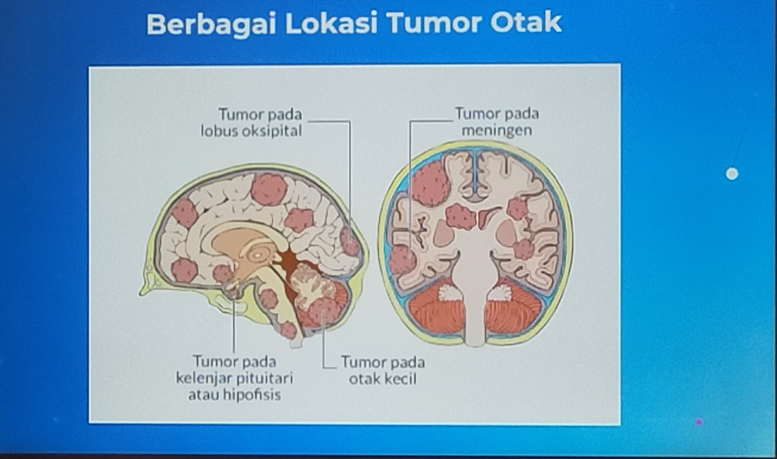 Berbagai lokasi tumor otak.