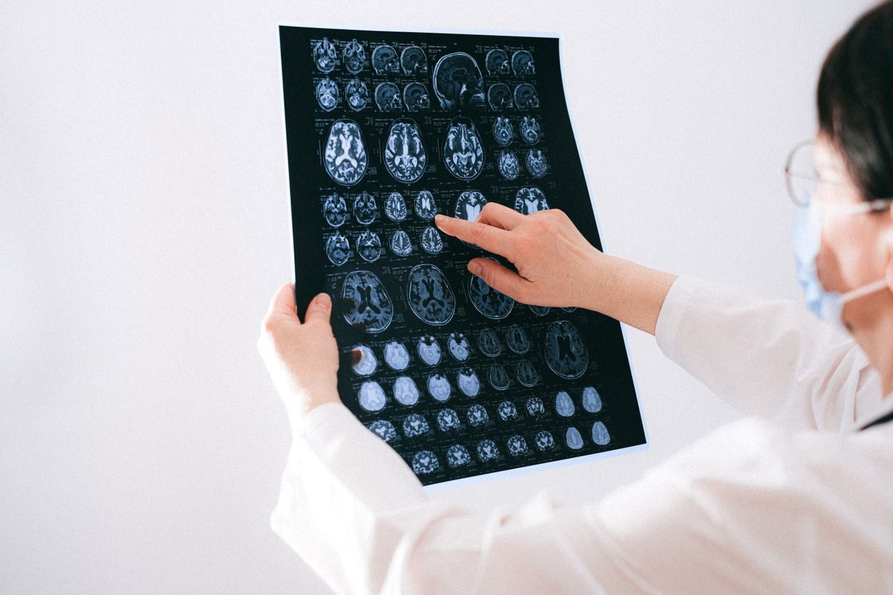 Sakit Kepala Berkepanjangan Bisa Jadi Gejala Tumor Otak, Dokter Ungkap Tanda yang Sering Diabaikan